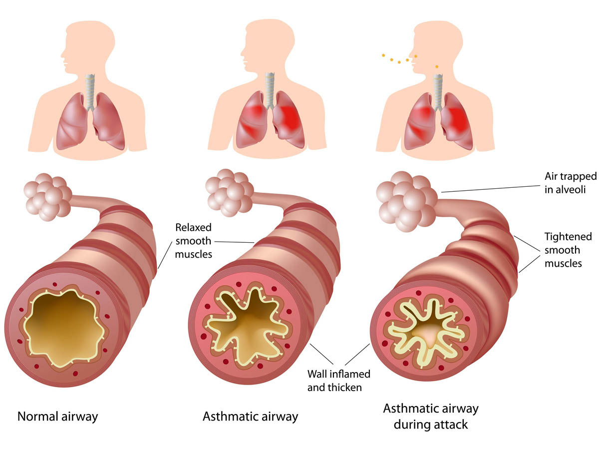 What causes my immune system to attack my lungs?